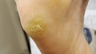 Professional treating cracked  Cracked treatment amp Callus removal  ASMR [upl. by Annirtak]