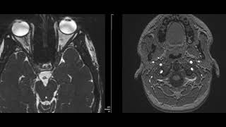 case 22 diplopia and squint [upl. by Cleti324]