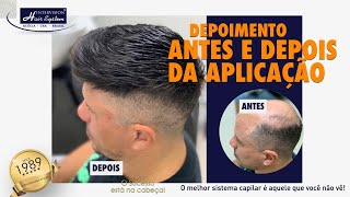 Como é utilizar uma Prótese Capilar AntesDepois  RELATO REAL Intervision Hair System [upl. by Ramiah310]