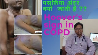 Hoovers sign in COPD  Dr Rahul Srivastava [upl. by Aicekal419]