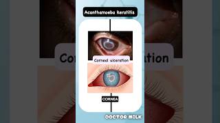 Acanthamoeba keratitis neetpg usmle ophthalmology [upl. by Nari]