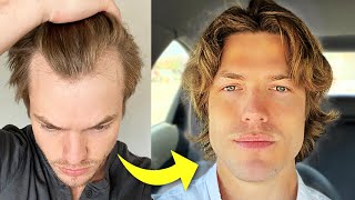 My Turkey Hair Transplant Results After 1 Year  Before amp After [upl. by Bil]