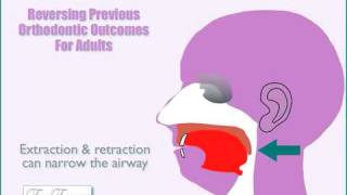 Can extractions headgear orthodontic appliances andor braces impact your airway amp breathing [upl. by Harcourt]