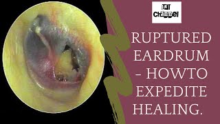 Ruptured eardrum I what should you do after traumatic perforation of tympanic membrane [upl. by Suoinuj391]