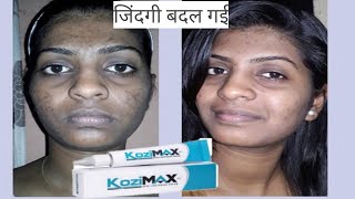 Kozimax Skin Lightening Cream  Uses Side effectsReviews Composition In Hindi [upl. by Anibas]