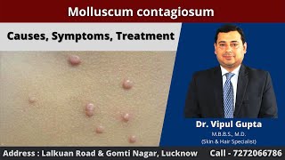 Molluscum contagiosum  Causes Symptoms Treatment [upl. by Eireva]