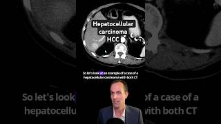 Abdominal CT Tutorials  Hepatocellular carcinoma HCC [upl. by Aeila]