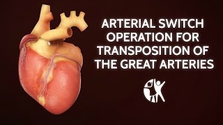 Arterial Switch Operation for Transposition of the Great Arteries  Cincinnati Childrens [upl. by Nerta]