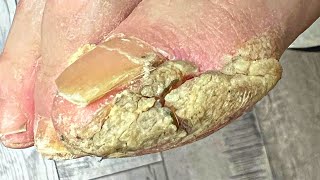 Trimming Extremely THICK And Cracked Callus [upl. by Neiman]