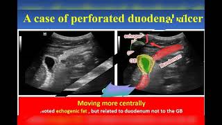 Perforated duodenal ulcer [upl. by Nanaek]