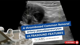 A thrombosed Common femoral artery pseudoaneurysm ultrasound features [upl. by Nesnar]