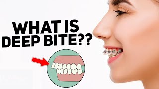 What is an overbite  deep bite httpswwwstraightsmilesolutionscom [upl. by Melita]