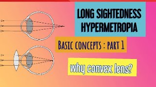 HYPERMETROPIA  BASICS to ADVANCED [upl. by Osswald]