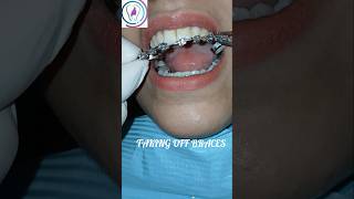 Fixed braces removal dentist orthodontics dentalbraces tooth islamabad rawalpindi [upl. by Ruggiero759]