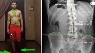 Lateral pelvic tilt amp Bulged disc FIX [upl. by Thamora]