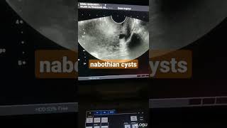 Nabothian cyst seen in the cervix ultrasound [upl. by Hultin]