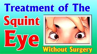 Squint Eye Treatment without Surgery I आँख के भेंगेपन की समस्या का उपचारबिना सर्जरी I Acupressure [upl. by Oicnedurp523]