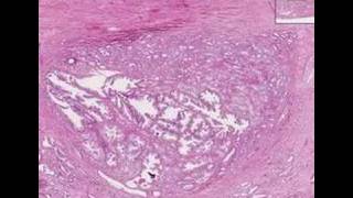 Histopathology ProstateAdenocarcinoma Gleason grade 1 [upl. by Staci]