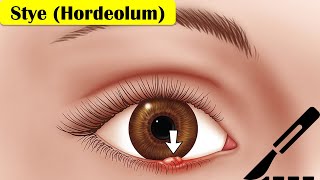 Stye Hordeolum  Causes Pathogenesis Signs amp Symptoms And Treatment [upl. by Latrell]