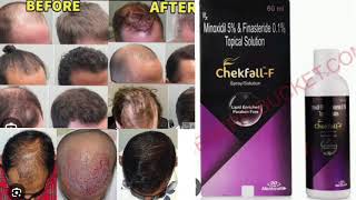 ChekfallF Spray Solution Minoxidil 5 amp Finasteride 01 Topical Solution [upl. by Etnovad218]