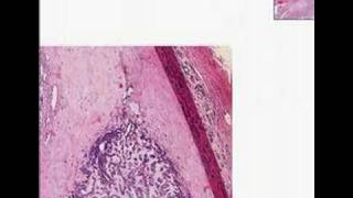 Histopathology Salivary glandAdenoid cystic carcinoma [upl. by Iglesias12]