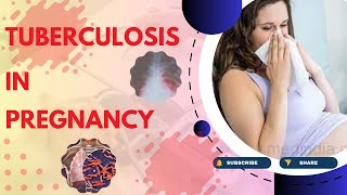 Tuberculosis in Pregnancy Causes Symptoms Diagnosis Treatment and Pathology  TOG Article [upl. by Cawley]