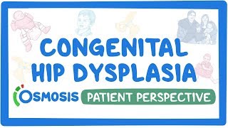 Patient Perspective Congenital hip dysplasia [upl. by Annat537]