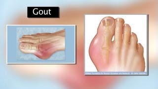 Gout  Mayo Clinic [upl. by Prosperus]