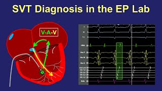 Diagnosis of SVT in the EP lab [upl. by Aikam918]