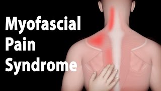 Myofascial Pain Syndrome and Trigger Points Treatments Animation [upl. by Ebaj]