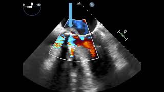 Prosthetic Aortic Valve Dehiscence with Paravalvular Leak blue arrow [upl. by Austine]