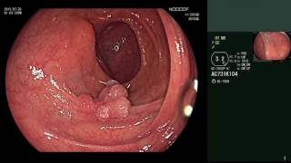 Endoscopic diagnosis of colon polyps using the NICE classification [upl. by Opiuuk]