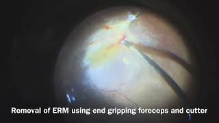 Unimanual approach for combined tractional rhegmatogenous RD [upl. by Mccallion408]