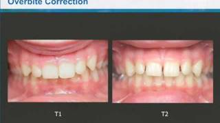 Dr Clark Colville  Class II Correction with Invisalign and the Carriere Distalizer [upl. by Noj293]