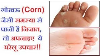 कॉर्न कील गोखरू का इलाज Corn Removal Home Remedies Corn Home TreatmentCorn ka Gharelu Ilaj Gokhru [upl. by Anjanette]