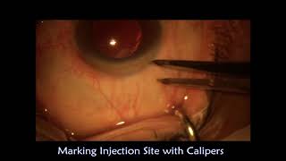 Intravitreal AntiVEGF Injections [upl. by Nayr]