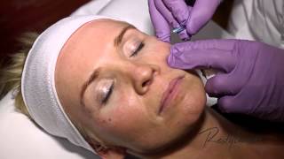 Dr Berne Harmony Program Oslo Azzalure Botox Restylane Tear Trough [upl. by Dami]