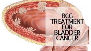 BCG TREATMENT FOR BLADDER CANCER [upl. by Eolcin]