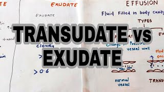 Transudate vs Exudate  Types of effusion  lights criteria [upl. by Rednasyl]