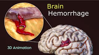 What Triggers Brain Hemorrhage  3D Animation  Scopic Vision [upl. by Nylirad]