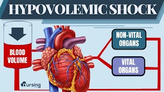 Hypovolemic Shock  Patho and Treatment Nursing [upl. by Aleafar]