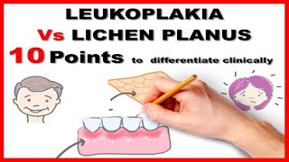 leukoplakia vs lichen planus  10 points to differentiate clinically [upl. by Aivatan]