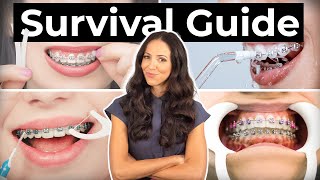 How To Prepare amp What To Expect With BRACES [upl. by Kopans]