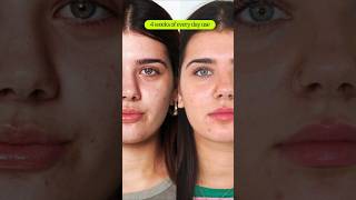 How to Treat Hormonal Acne Before amp After  eyeam 👁️ ❇️ wellness [upl. by Khanna]