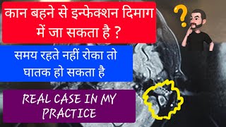 Ear discharge can affect brain  कान बहता है तो इग्नोर नहीं करें  इन्फेक्शन दिमाग में जा सकता है [upl. by Hola]