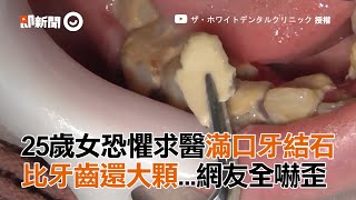 25歲女恐懼求醫滿口牙結石 比牙齒還大顆 網友全嚇歪 25の女性歯医者恐怖症治すついでに歯石取ってくれた！超大量歯石！ 療癒 [upl. by Stedman936]