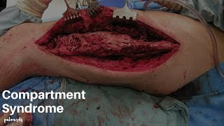 Emergency Medical Treatment Compartment Syndrome [upl. by Hgielrebma]