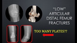 Low Distal femur fractures Complex injuries minimal or maximum fixation [upl. by Amsirahc]