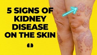 5 Signs of Kidney Disease On The Skin [upl. by Amej]