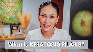 What is Keratosis Pilaris and how to Treat it  Dr Gaile RobredoVitas [upl. by Dupin857]